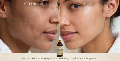 Turmeric Oil - Your Glow in a Bottle. Anti-Aging & Acne Reducing, Hydrates and Brightens!