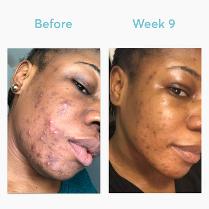 hyaluronic acid skin care products moisturizing anti aging & acne removal